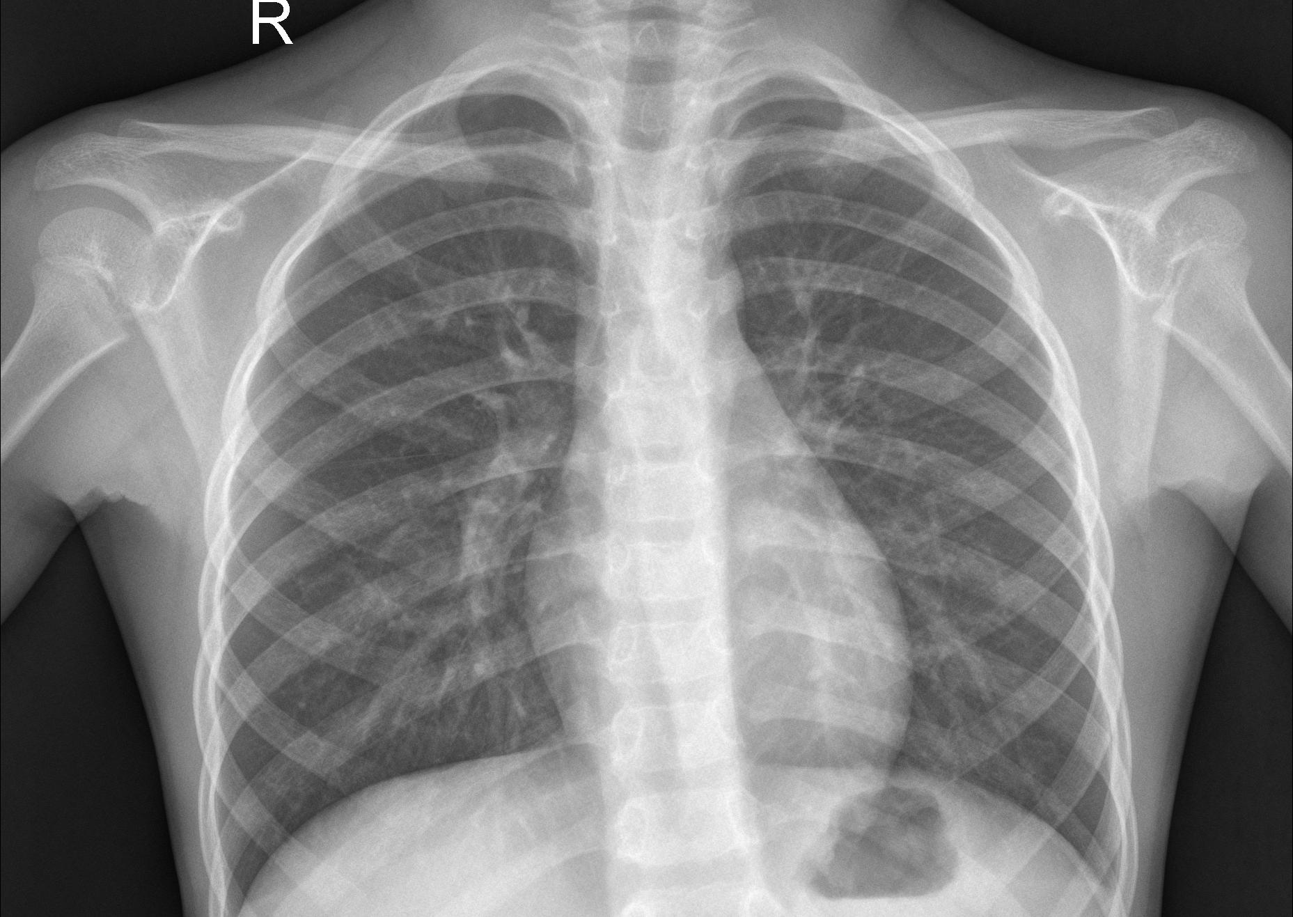 Normal Lung