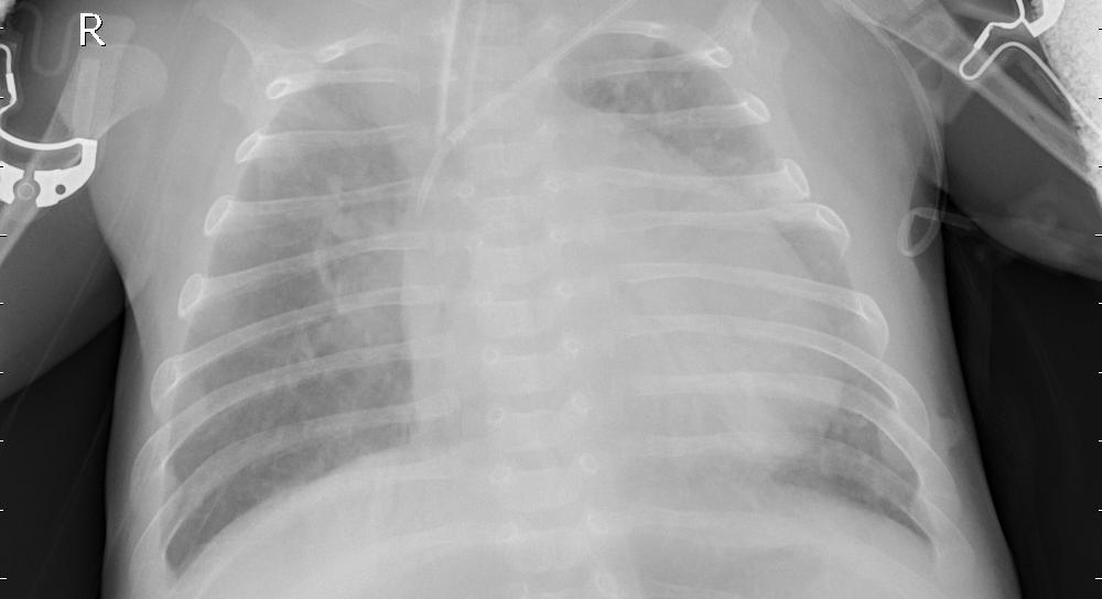 Viral Pneumonia Lung