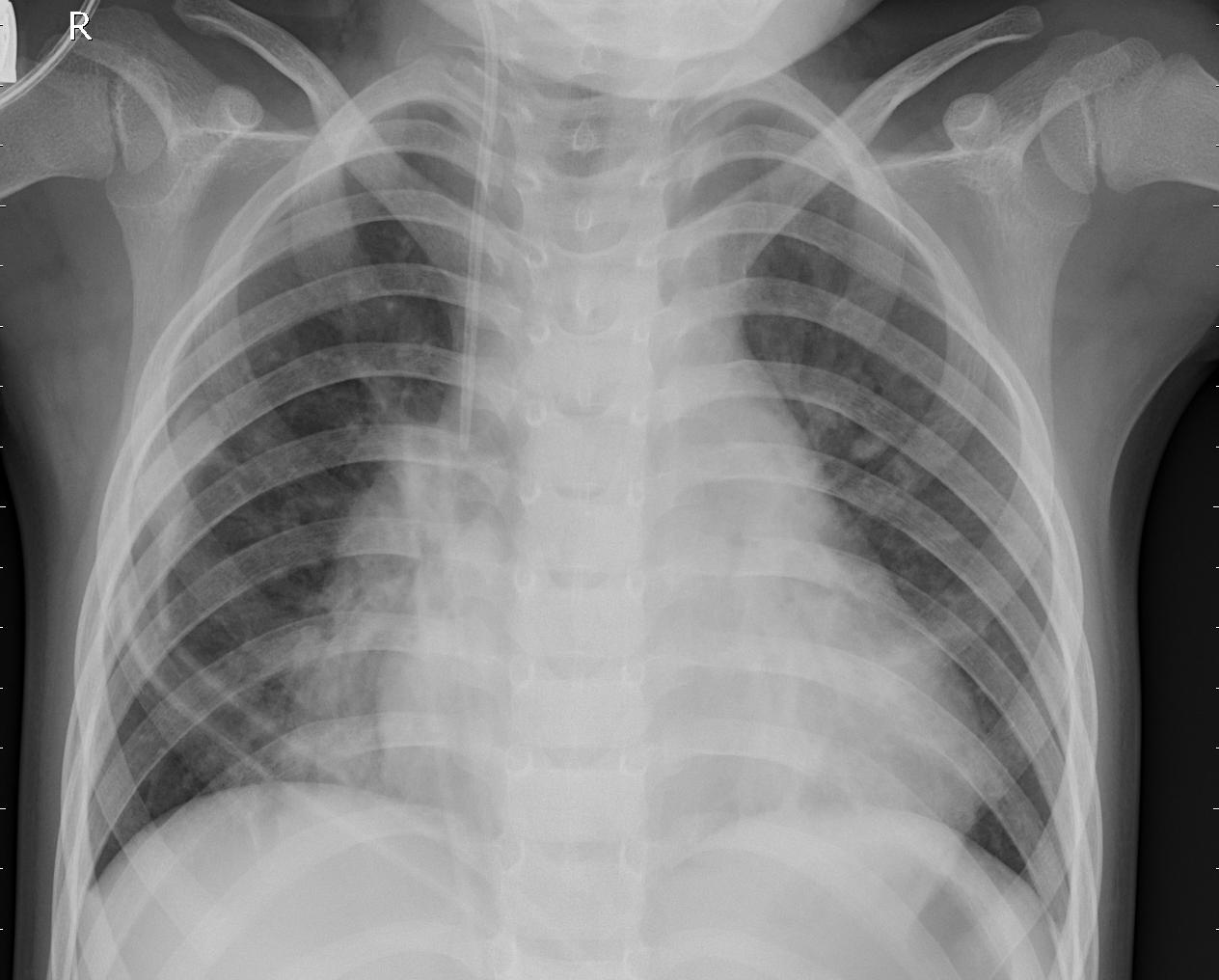 Bacterial Pneumonia Lung